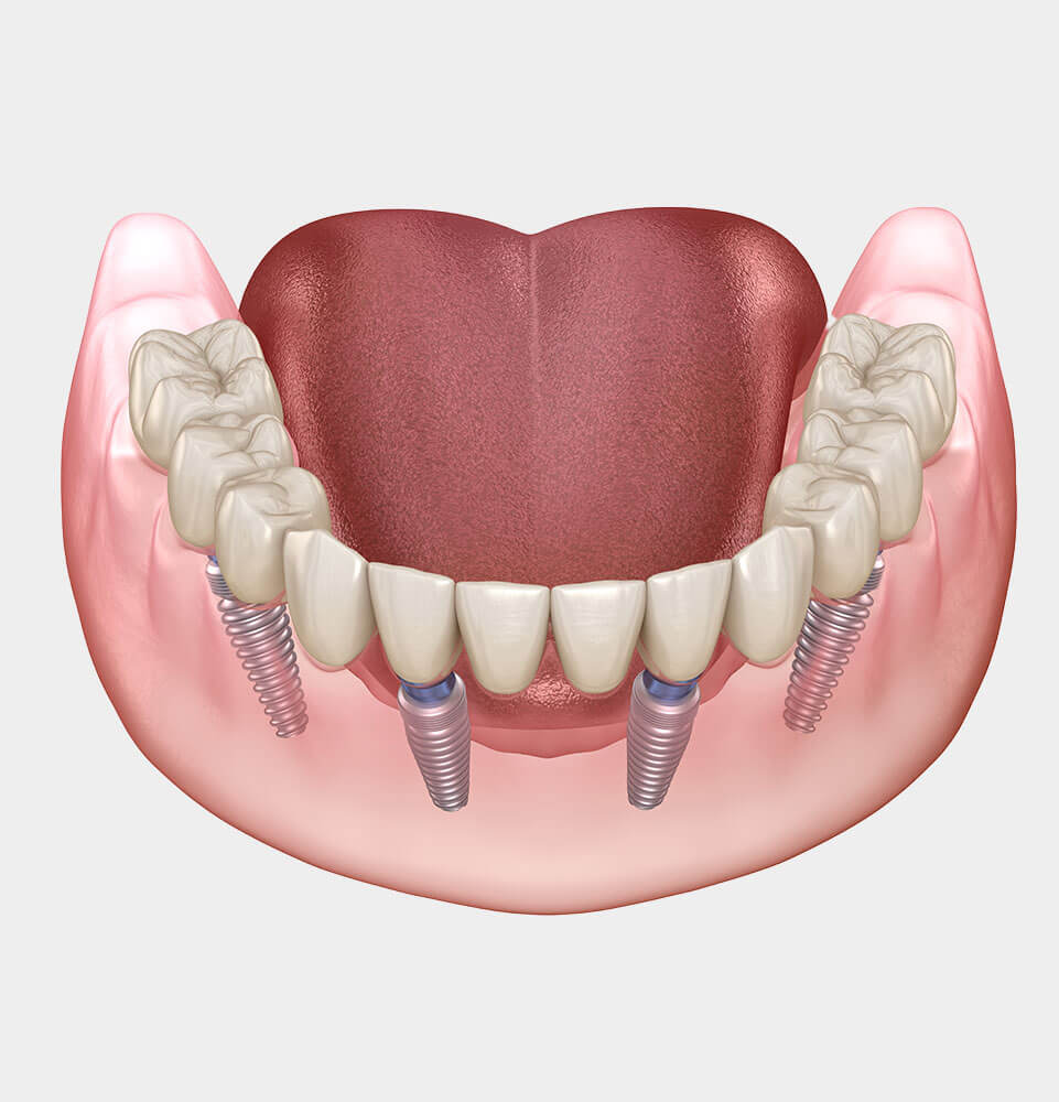 All-On-X Full-Mouth Dental Implants