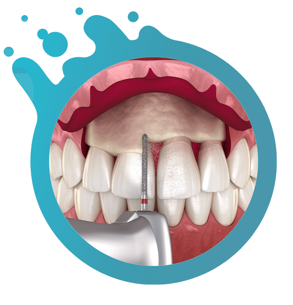 close up illustration of crown lengthening