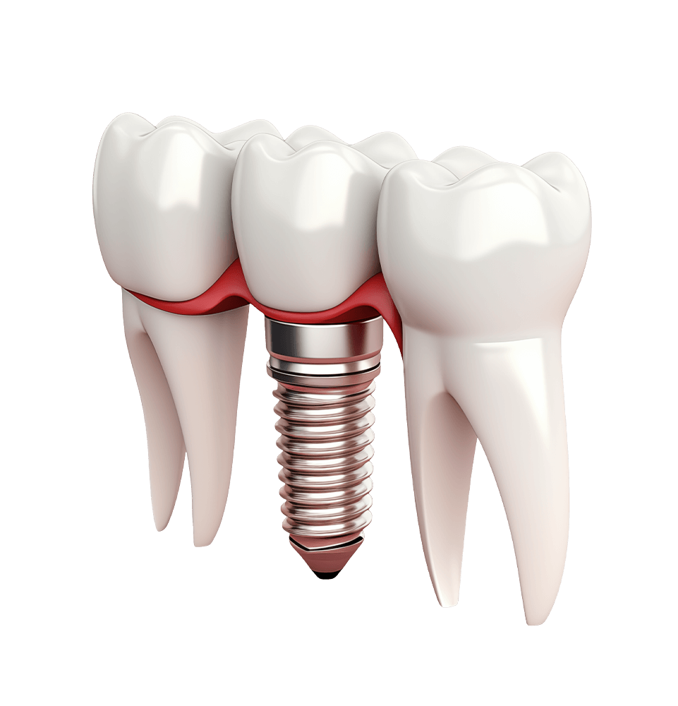 Dental Implants