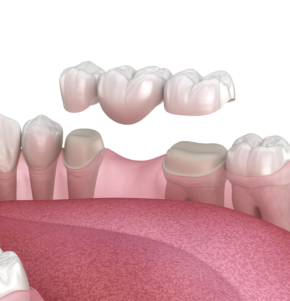 Dental Bridge