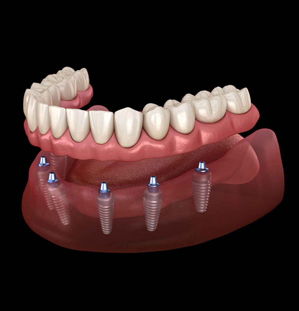 Implant-Supported Dentures