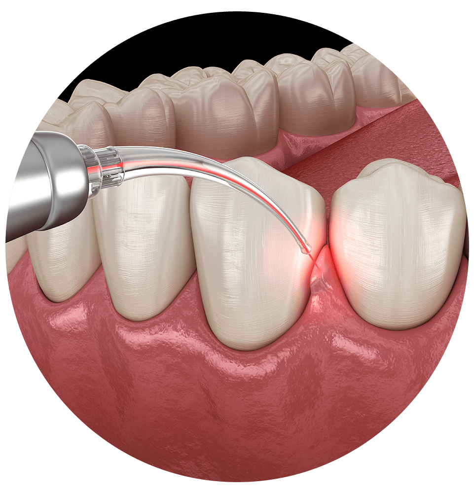 Laser Gum Treatment icon