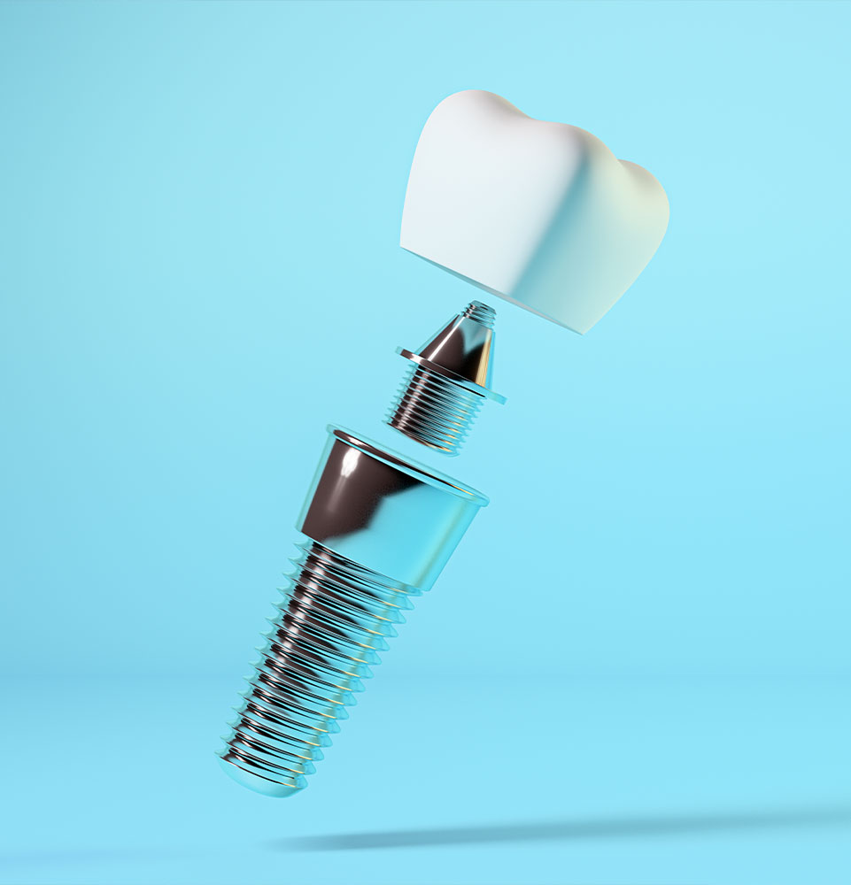 Single Dental Implant